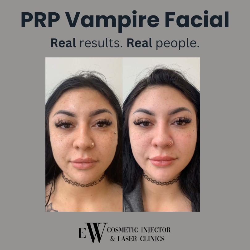 ew cosmetic - vampire facial before afters